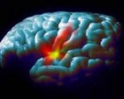 Болезнь Паркинсона