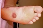 Врачи выявили первый случай наличия соска на подошве ноги