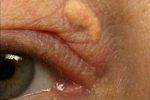 Бляшки на веках предупреждают о сердечном приступе