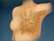 Рак груди: новейшие методы лечения