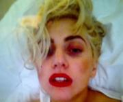 Леди Гага похвасталась синяками