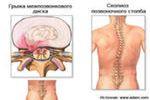 Диагностика и лечение грыжи межпозвоночного диска