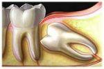 Зубы мудрости. Удаление зубов