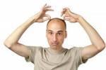 Причины облысения
