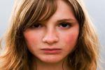 Покраснение лица. Какие заболевания могут стать этому причиной?