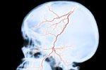 Врачи выяснили, как остановить процесс повреждения мозга, вызванный инсультом