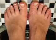 Все о грибке ног и как предотвратить его появление