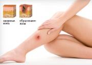 Лечение трофической язвы народными средствами