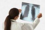 На риск возникновения рака легких влияют хронический бронхит, эмфизема легких и пневмония