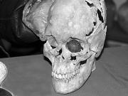 Медицина каменного века