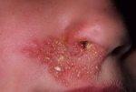 Как бороться с герпесом