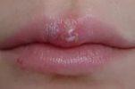 Народные  средства  при герпесе на губе